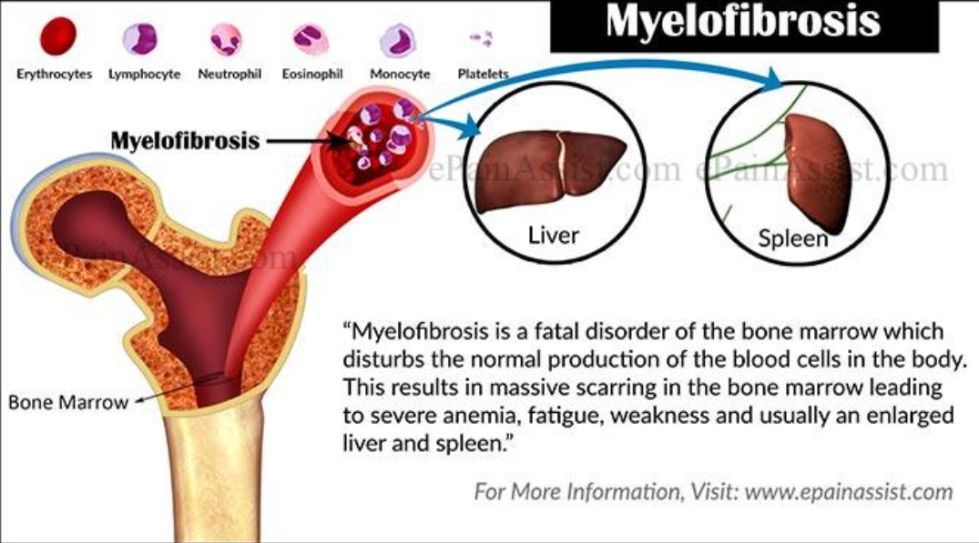 Myelofibrosis | The DADA2 Foundation