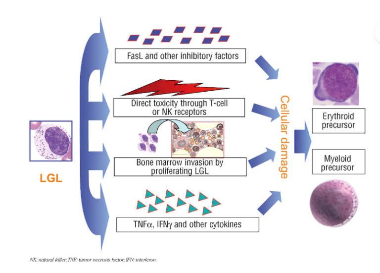 T Cell Large Granular Lymphocytic Lymphoproliferations | The DADA2 ...