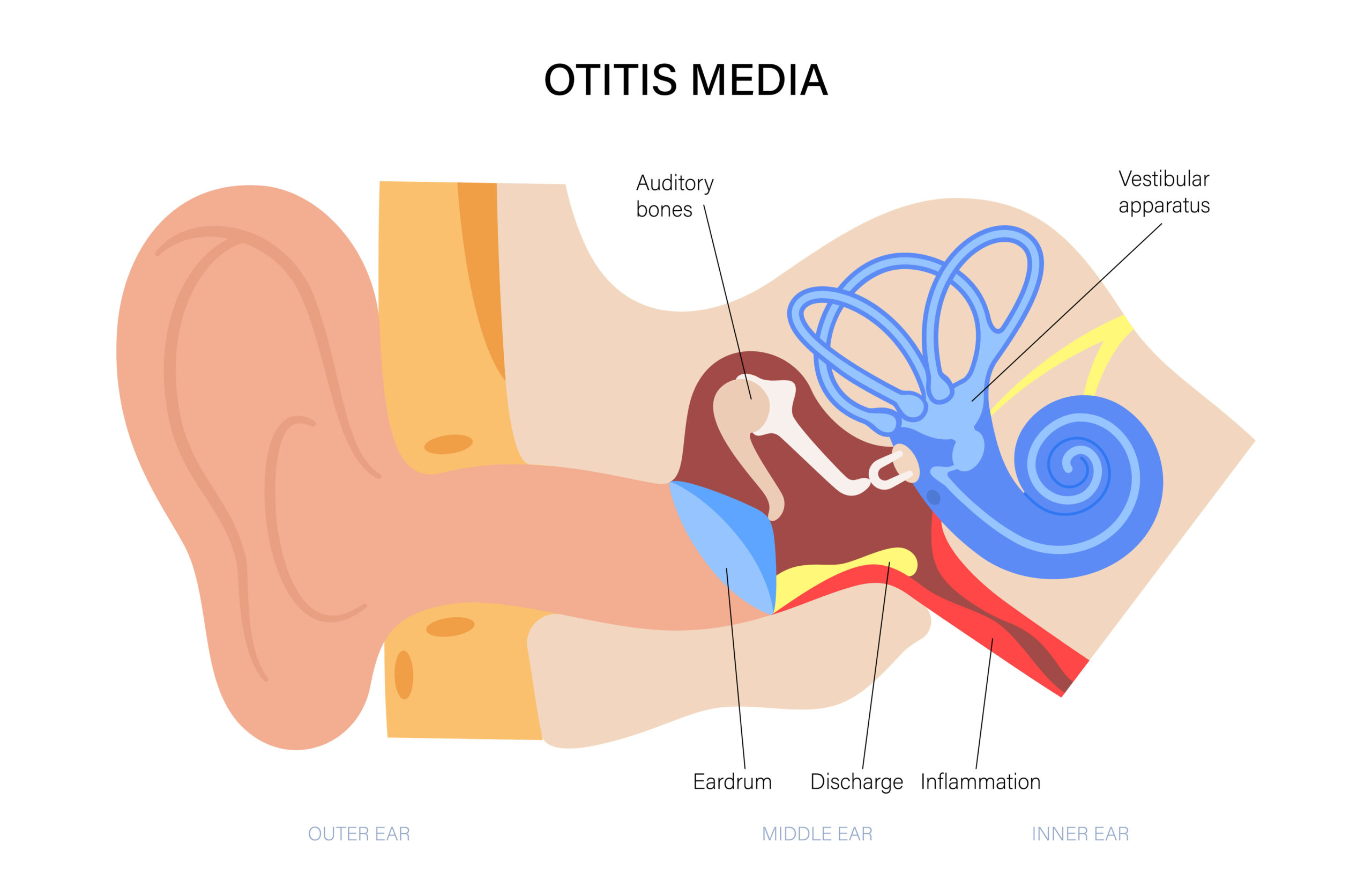 recurrent-otitis-media-the-dada2-foundation