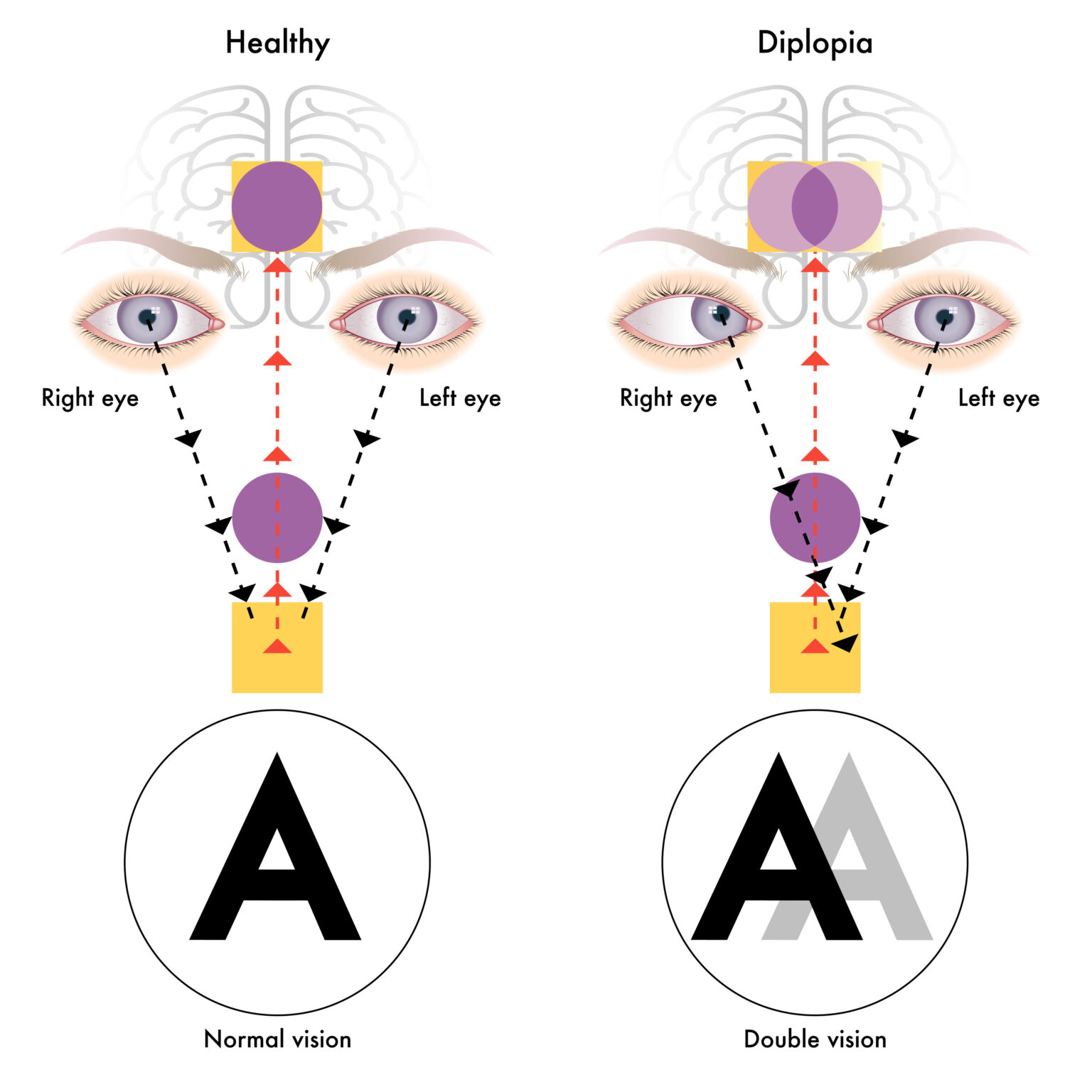 Diplopia | The DADA2 Foundation