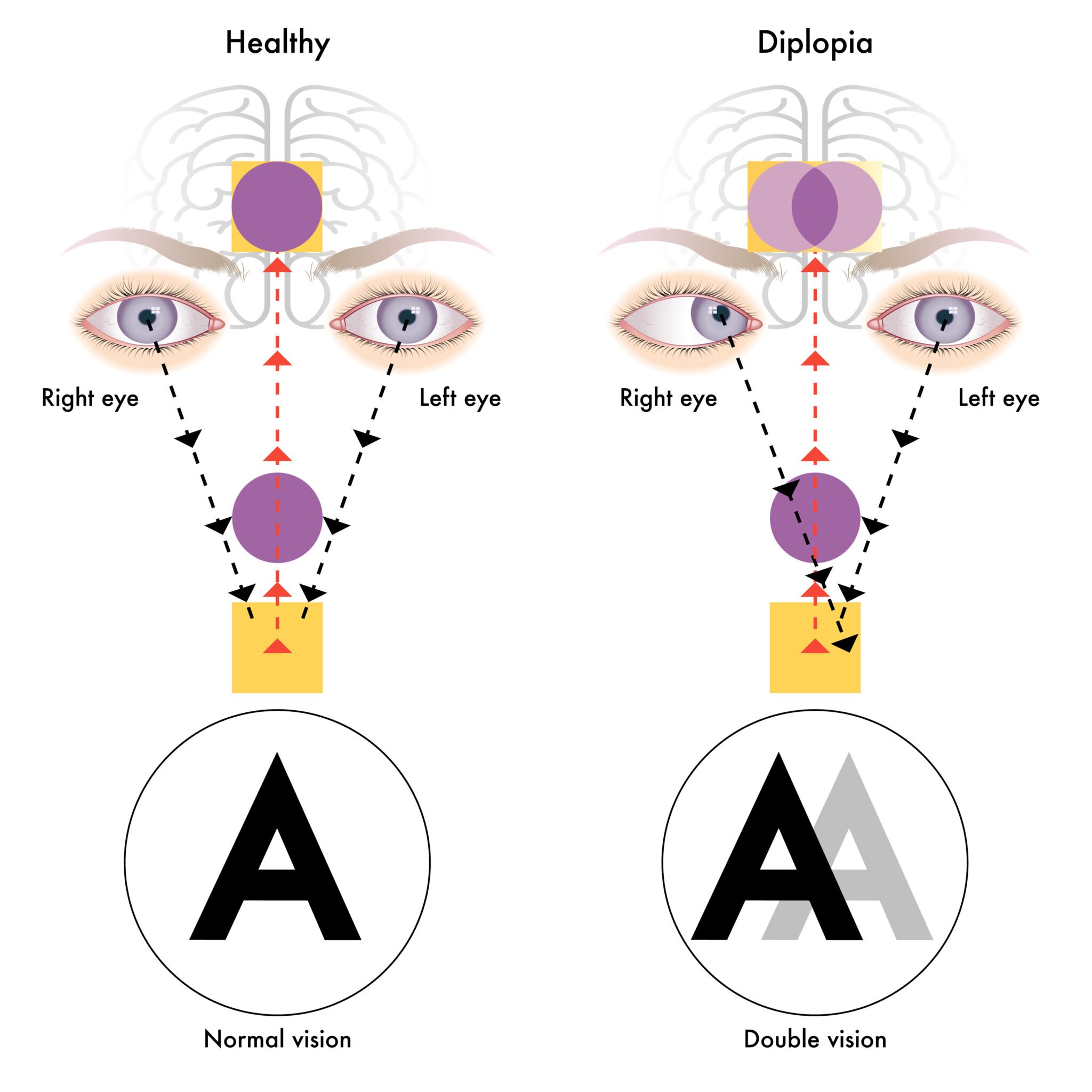 Diplopia | The DADA2 Foundation