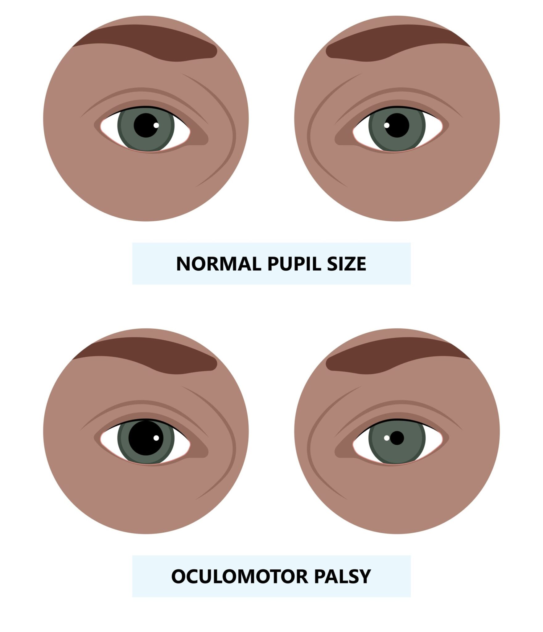 Oculomotor Nerve Palsy | The DADA2 Foundation