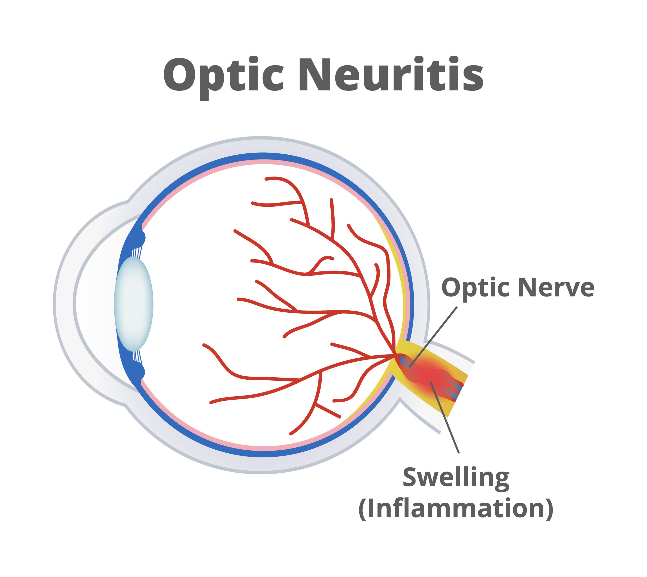 optic-neuritis-the-dada2-foundation