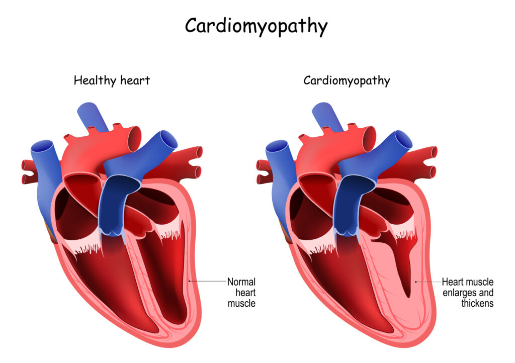a diagram of a healthy heart vs one with cardiomyopathy