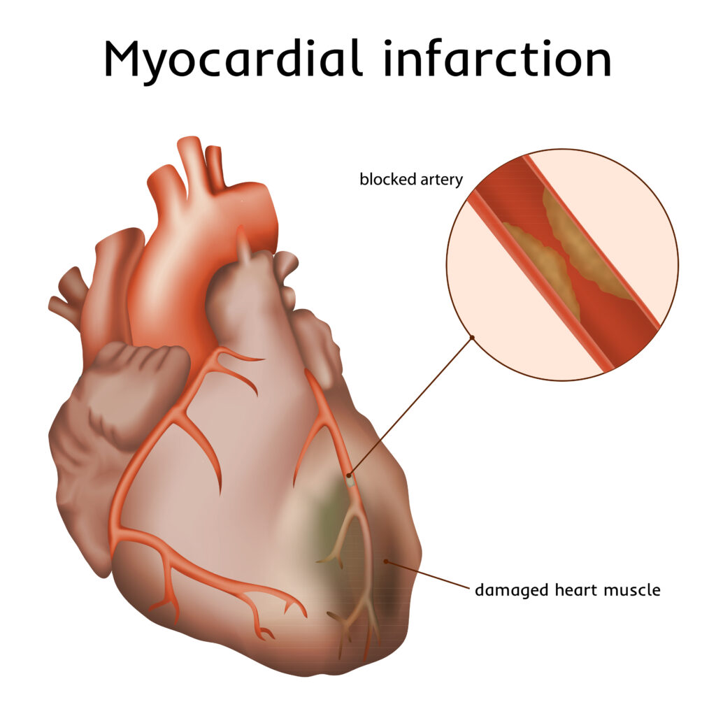 diagram of a myocardial infarction