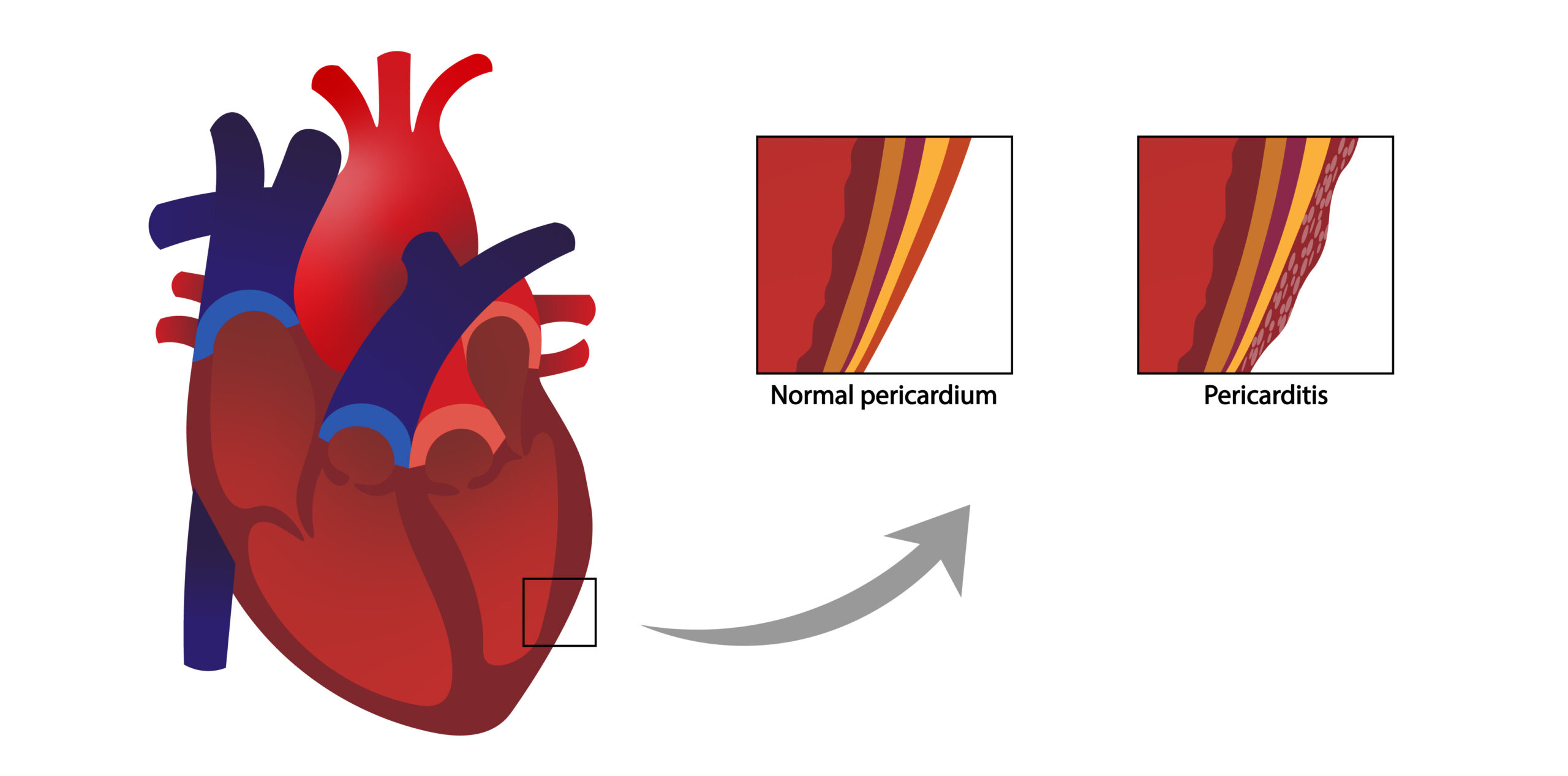 pericarditis-the-dada2-foundation