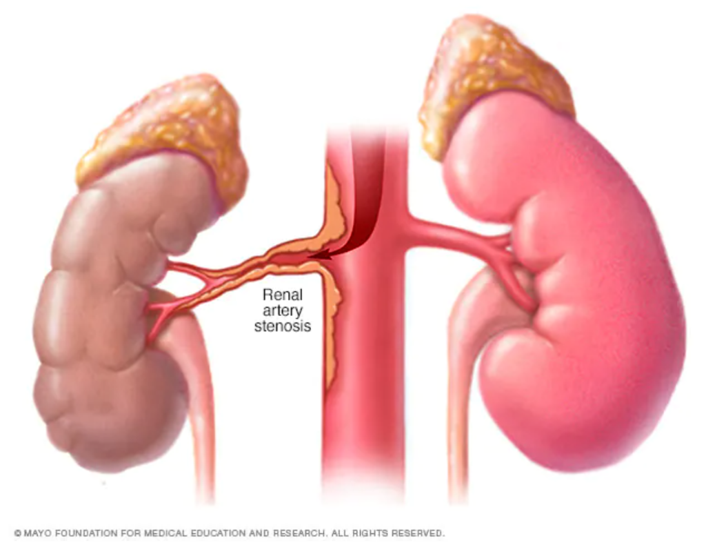 diagram of renal artery stenosis