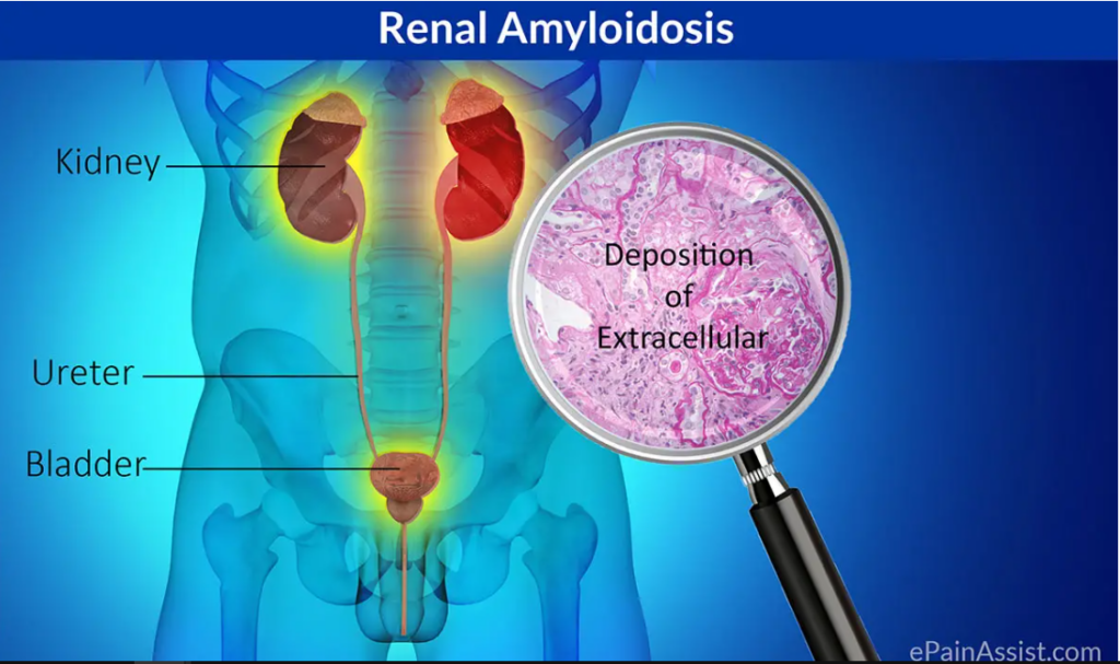 diagram of renal amyloidosis