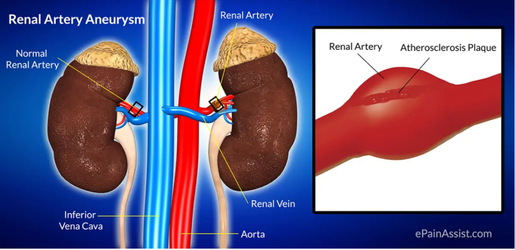 diagram of renal artery aneurysm