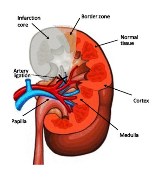 diagram of renal infarction