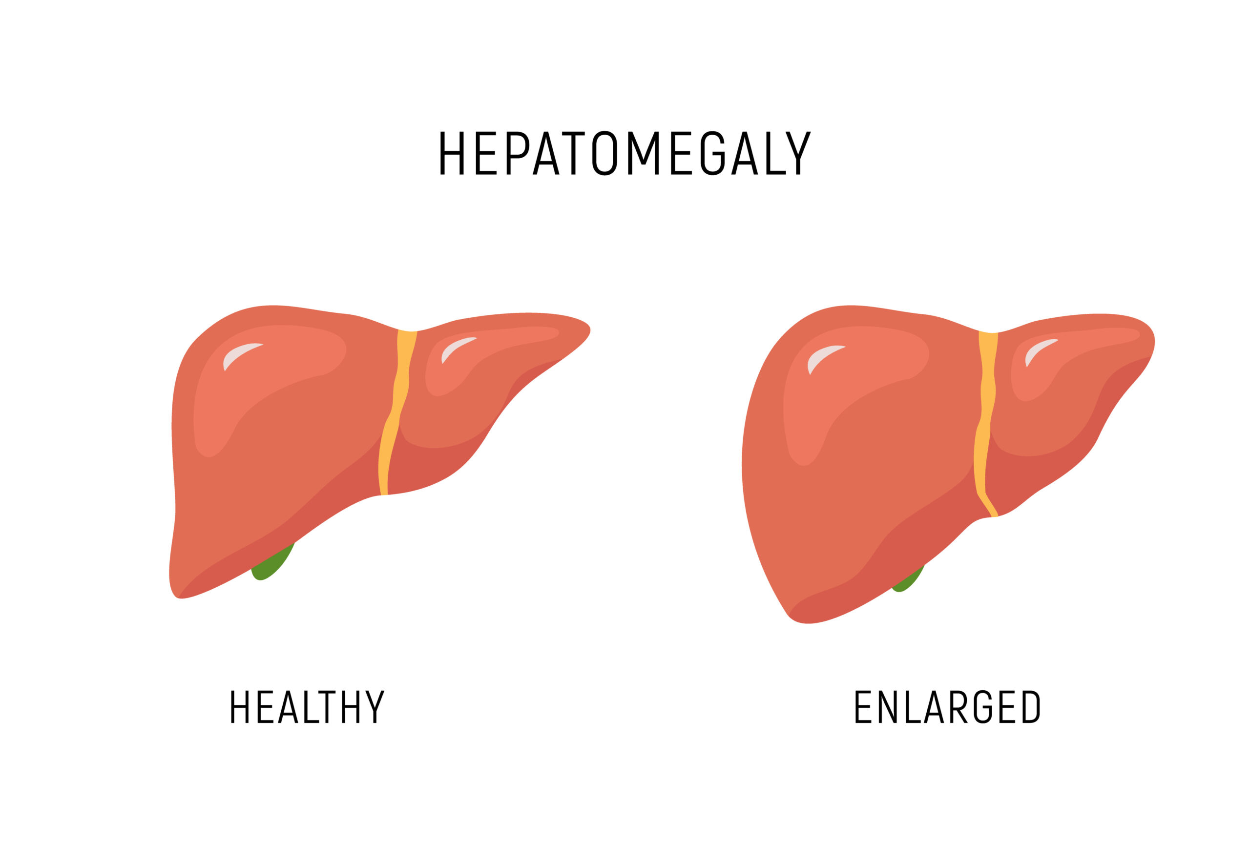 Hepatomegaly | The DADA2 Foundation