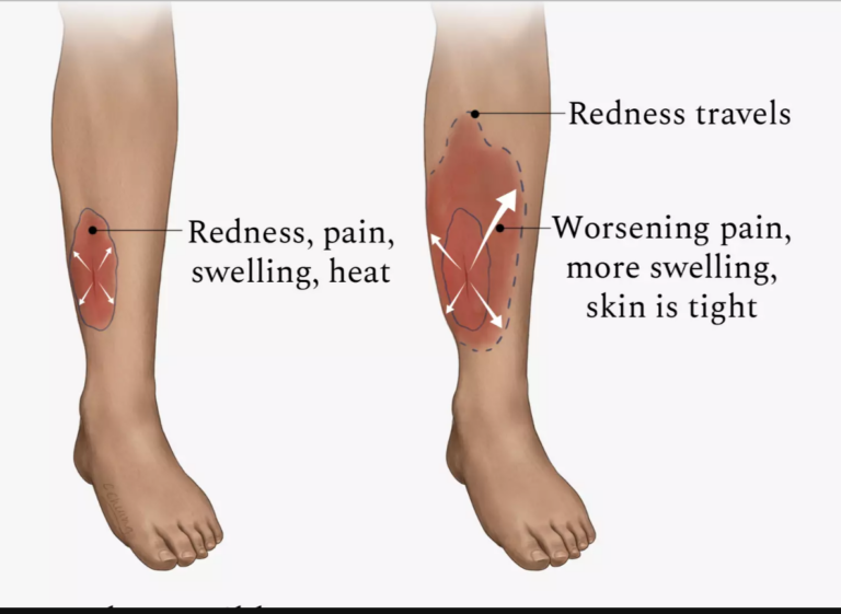 Cellulitis | The DADA2 Foundation